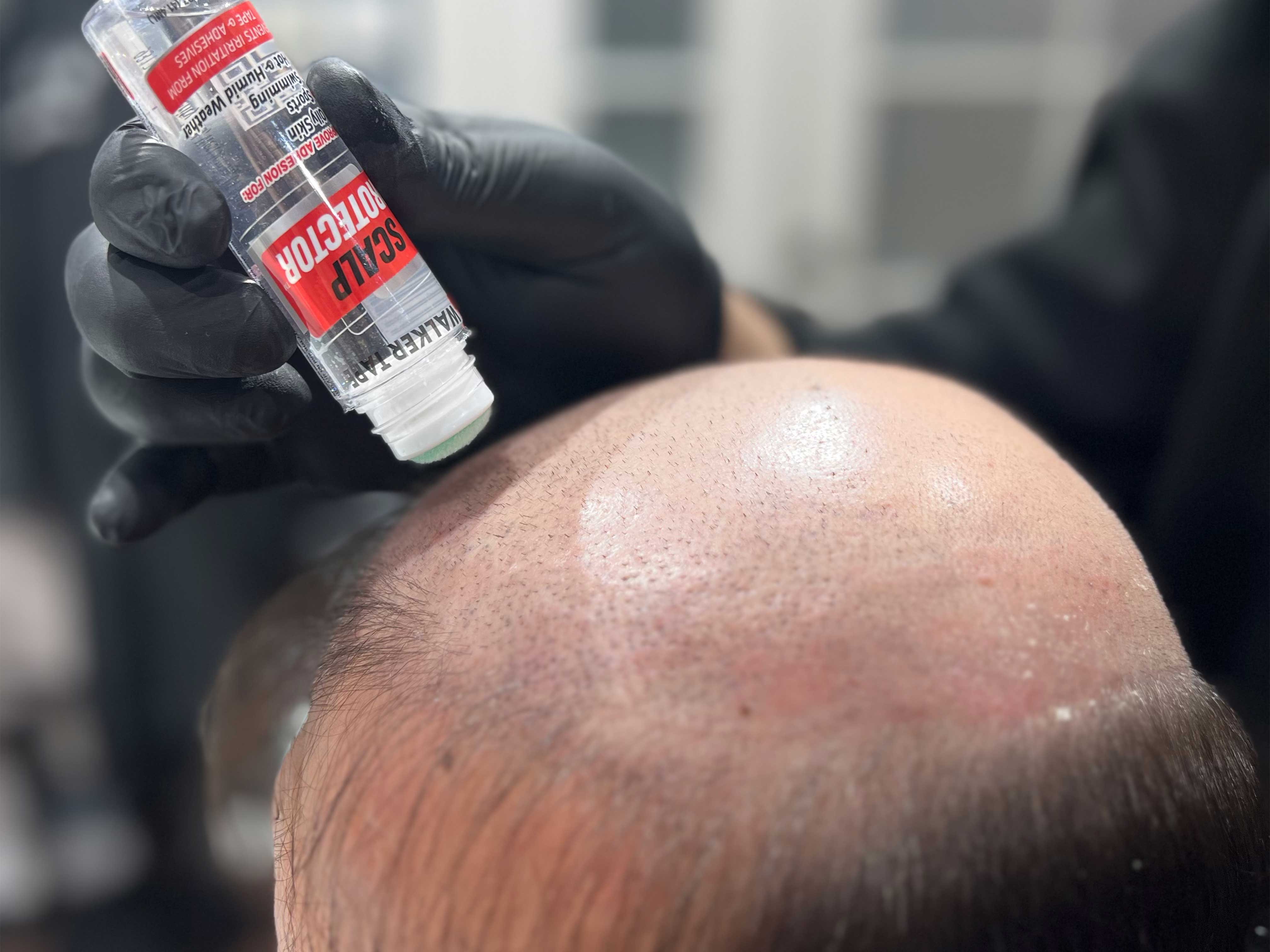 2. Scalp Protector Uygulama Şekli
