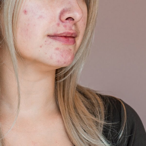 Sensatia Çay Ağacı & Limon Sivilce Karşıtı Hangi Cilt Tipleri İçin Etkilidir?