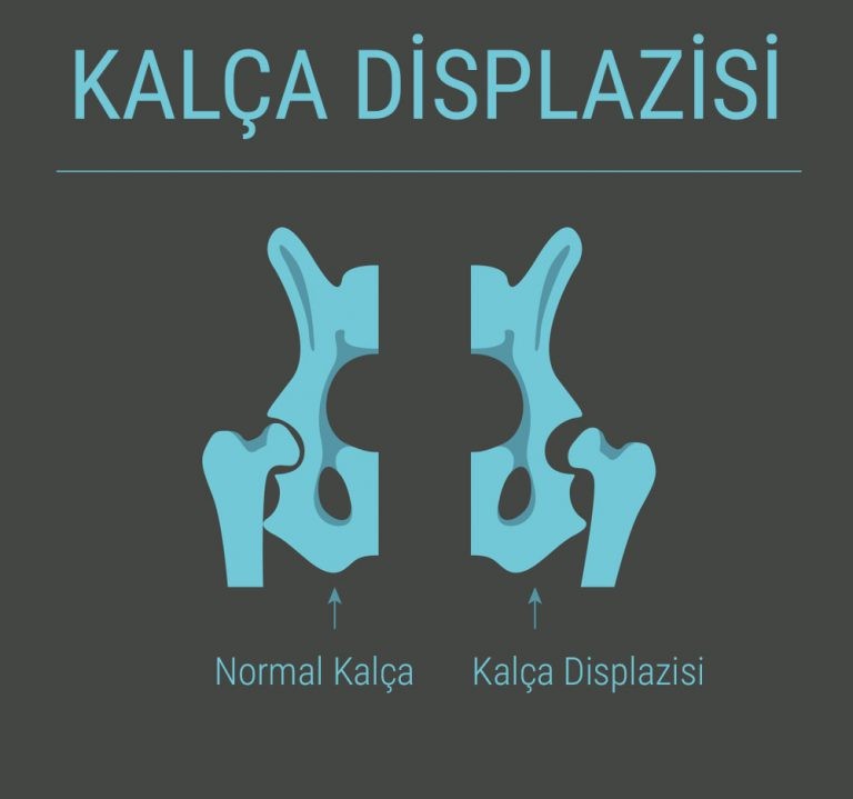 Kalça Dizplazisi