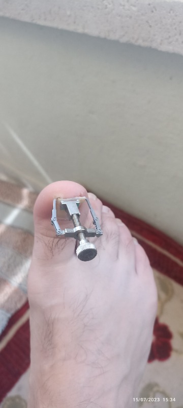 Nail Batık Batan Tırnak Sökme Aparatı