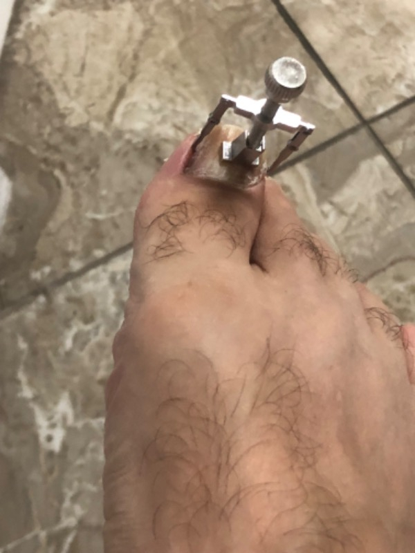 Nail Batık Batan Tırnak Sökme Aparatı Metal Kutusunda Hızlı Etki Gösteren Cihaz