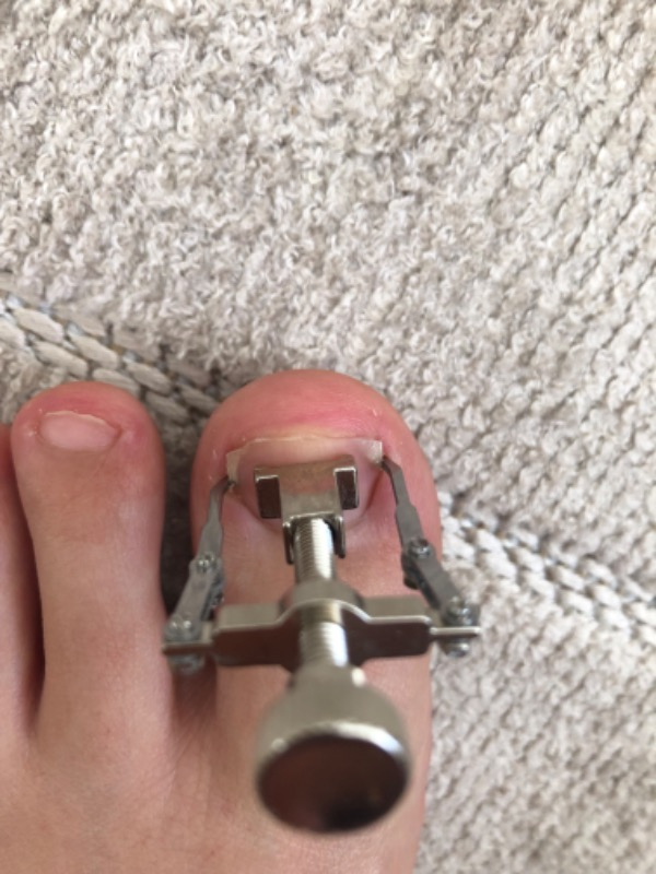 Nail Batık Batan Tırnak Sökme Aparatı