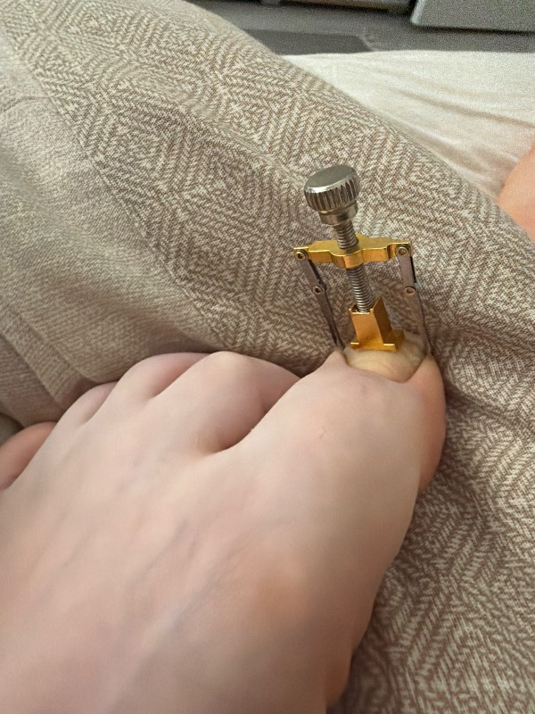 Nail Batık Batan Tırnak Sökme Aparatı