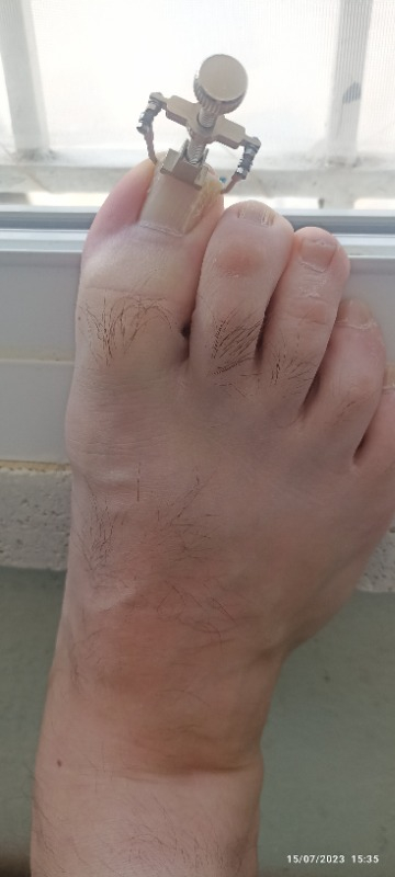 Nail Batık Batan Tırnak Sökme Aparatı
