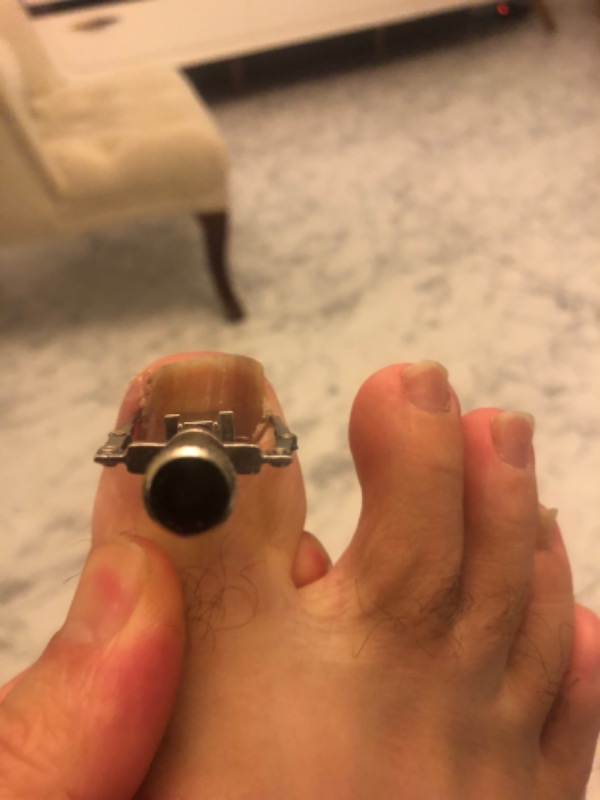 Nail Batık Batan Tırnak Sökme Aparatı Metal Kutusunda Hızlı Etki Gösteren Cihaz