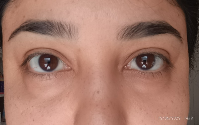 Avon Ideal Flawless Stick Concealer Kapatıcı Medium